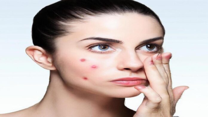 iRespuestas.com | ¿Cómo eliminar marcas de acné?